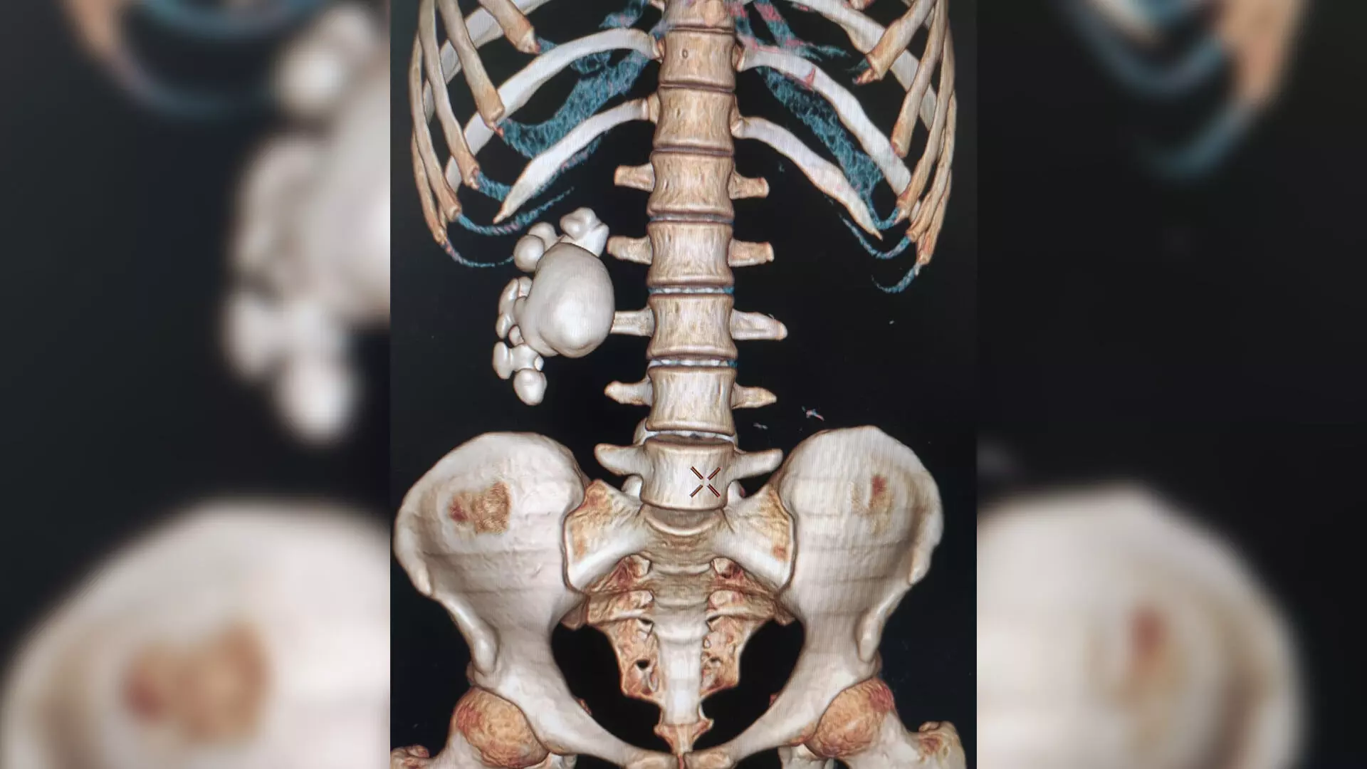 AINU doctors remove Staghorn kidney stones using minimally-invasive procedure from 20YO patient